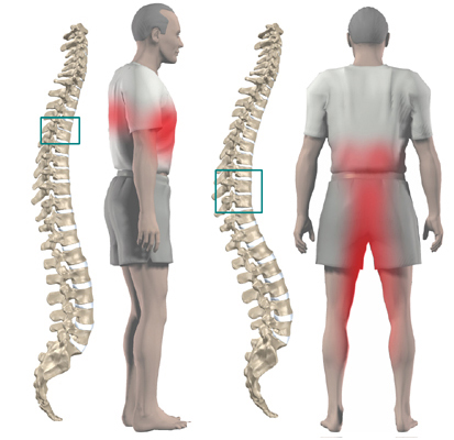 Hệ quả của thói quen xấu - tình trạng thoát vị đĩa đệm gây nên triệu chứng đau vùng thắt lưng
