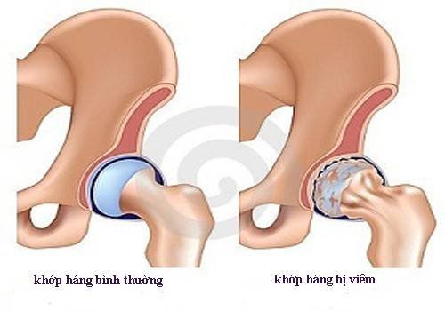 Viêm đau khớp háng và cách điều trị an toàn, hiệu quả