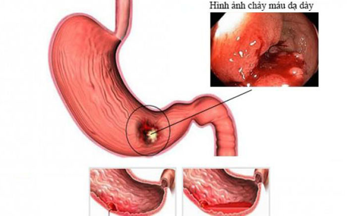 Xuất huyết dạ dày thường do thương tổn từ bệnh viêm loét dạ dày  