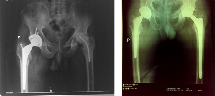 Chụp x-quang để thấy rõ các tổn thương của xương khớp khi viêm đau khớp háng