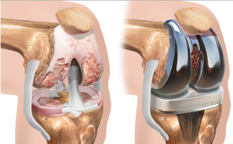 1. Tổng Quan Về Thoái Hóa Khớp Gối