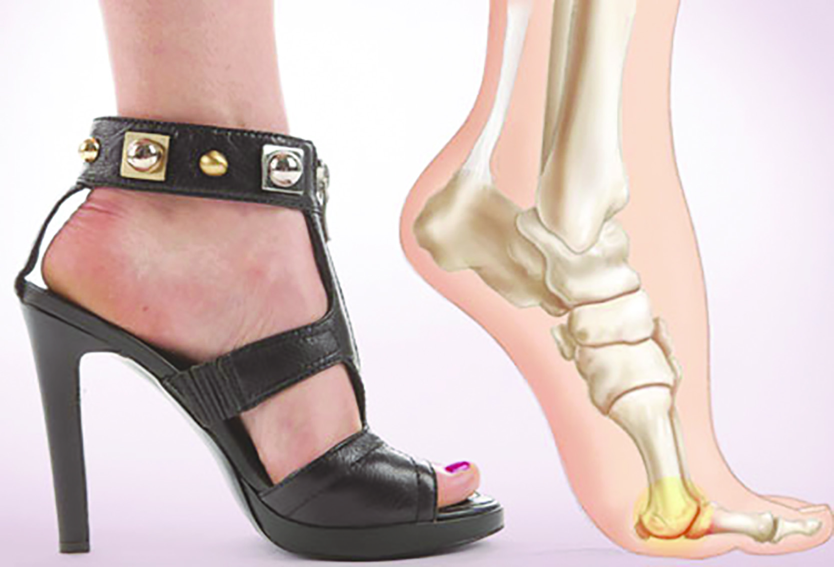 Mang giày cao gót là nguyên nhân dẫn đến bệnh đau cơ xương khớp