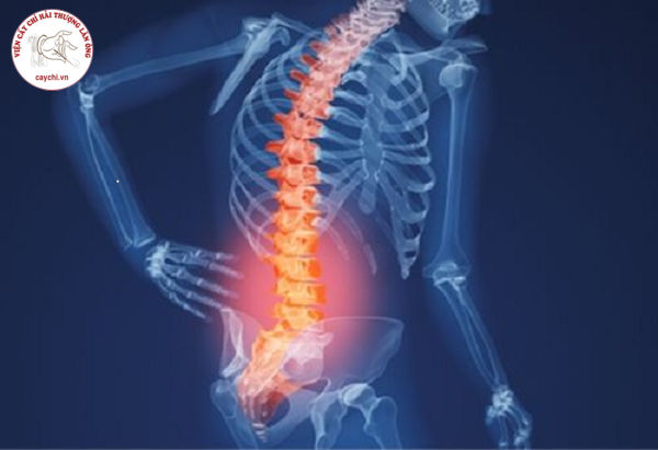 Đau mỏi vùng thắt lưng có sự lan tỏa theo các đường dây thần kinh là biểu hiện của thoái hóa cột sống thắt lưng