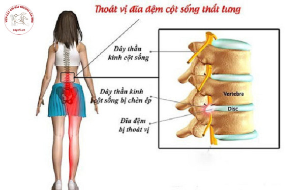 Thoát vị đĩa đệm có thể gặp ở bất cứ vị trí nào trên cột sống như phổ biến nhất là cổ và thắt lưng