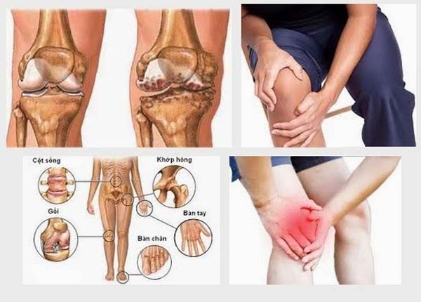 Cột sống, gối, đĩa đệm, bàn tay, bàn chân là các vị trí dễ mắc bệnh xương khớp