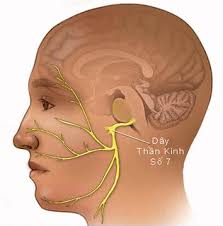 Khi dây thần kinh điều khiển vận động mặt bị tổn thương sẽ gây ra tình trạng méo mặt, khó nhắm mắt,....