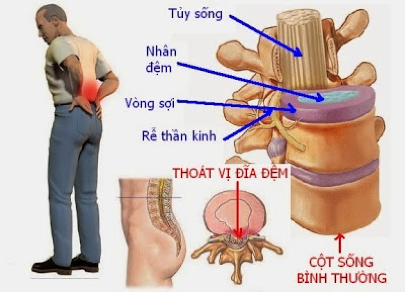Thoát vị đĩa đệm thường gây nên những cơn đau nhức tại vùng hông
